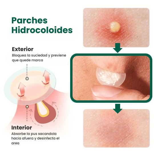 Some By Mi - 30 Days Miracle Clear Spot Patch 18pcs | Parches Hidrocoloides