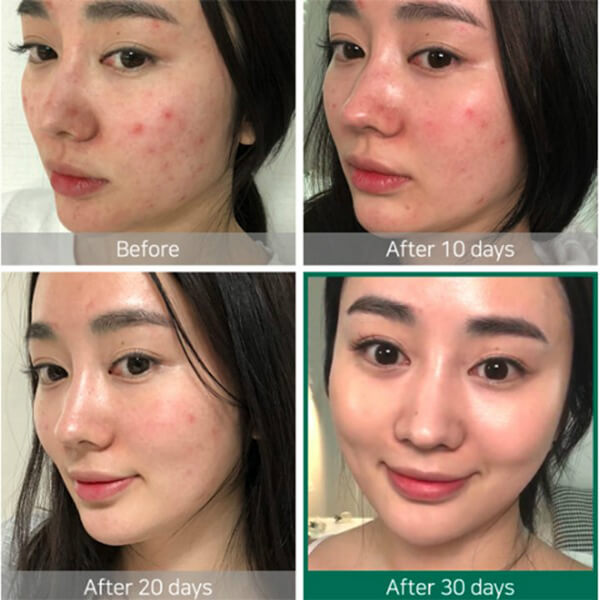 SOMEBYMI - AHA.BHA.PHA 30 Days Miracle ACNE SOS KIT